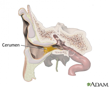 Experto advierte de que el tapón de cerumen es una de las causas más comunes de pérdida de audición